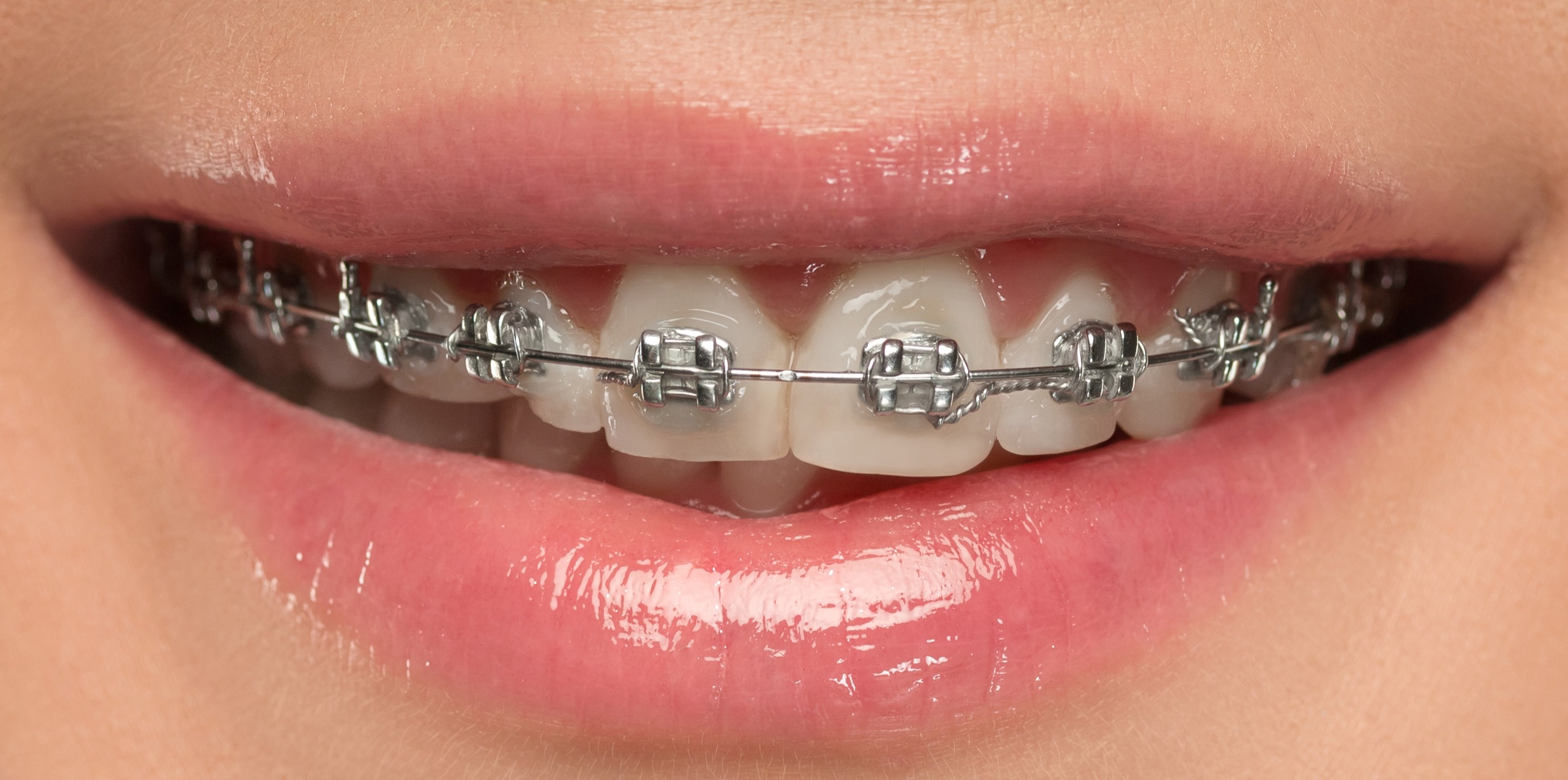 Brackets metálicos