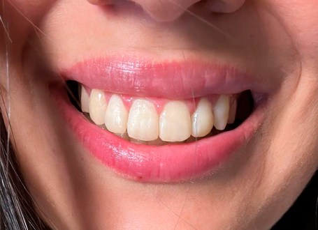 Restauraciones estéticas