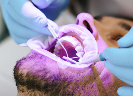 Tratamiento de caries